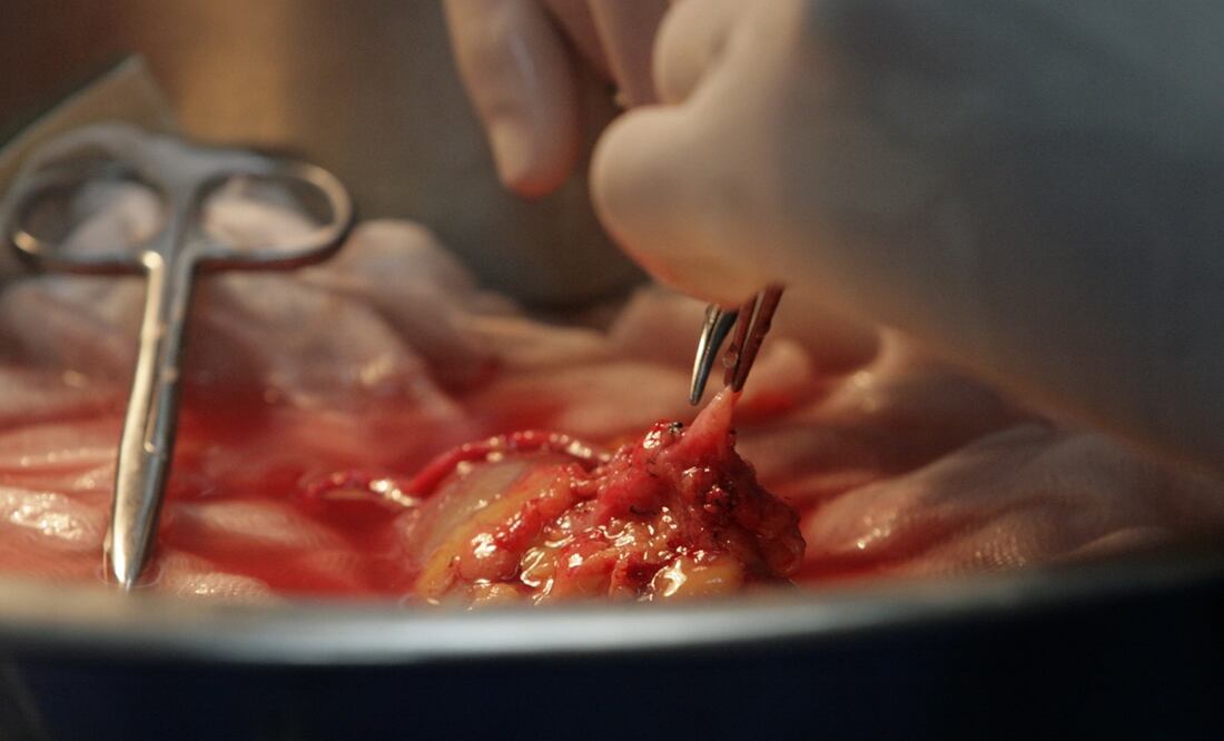 Trasplante renal. Foto: El Universal, archivo