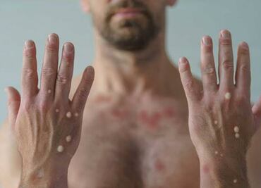 Reportan nuevo paciente con viruela de mono en Sinaloa; suman 9 casos