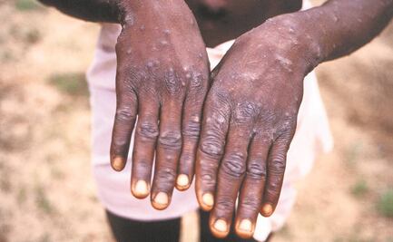 México enciende alerta por viruela del mono