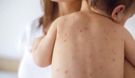 Casos de sarampión casi se cuadruplican en el mundo durante 2019: OMS