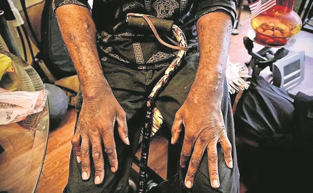 Las cicatrices causadas por las inyecciones diarias de drogas en los brazos de Lorando Duncan, de 65 años, sentado en su apartamento en Washington, DC, Estados Unidos. Foto: Agnes Bun / AFP