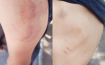 Agreden físicamente a menor resguardado en Casa del Niño DIF en Pachuca; responsabilizan a encargado de seguridad