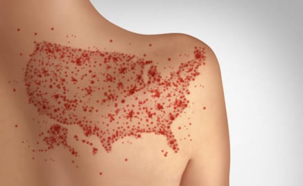 Sarampión se extiende a 9 estados de EU; la mayoría de casos no están vacunados