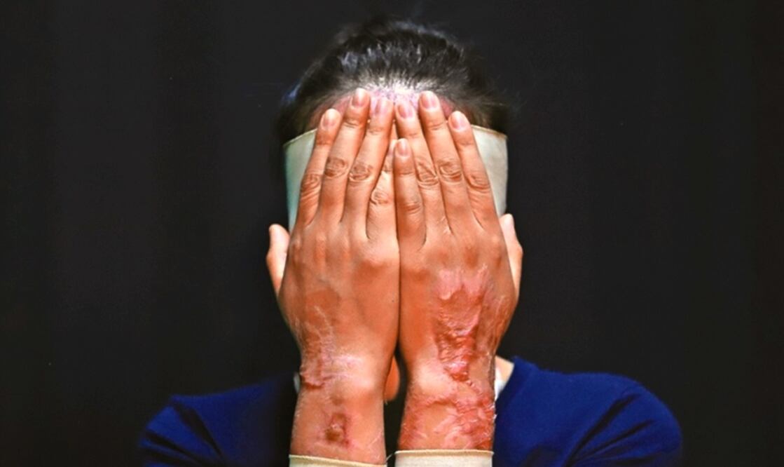 Violencia ácida. Foto: archivo/EL UNIVERSAL