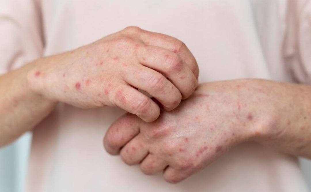 Los pacientes con urticaria crónica tardan más de 3 años en ser diagnosticados. Fuente: Freepik.