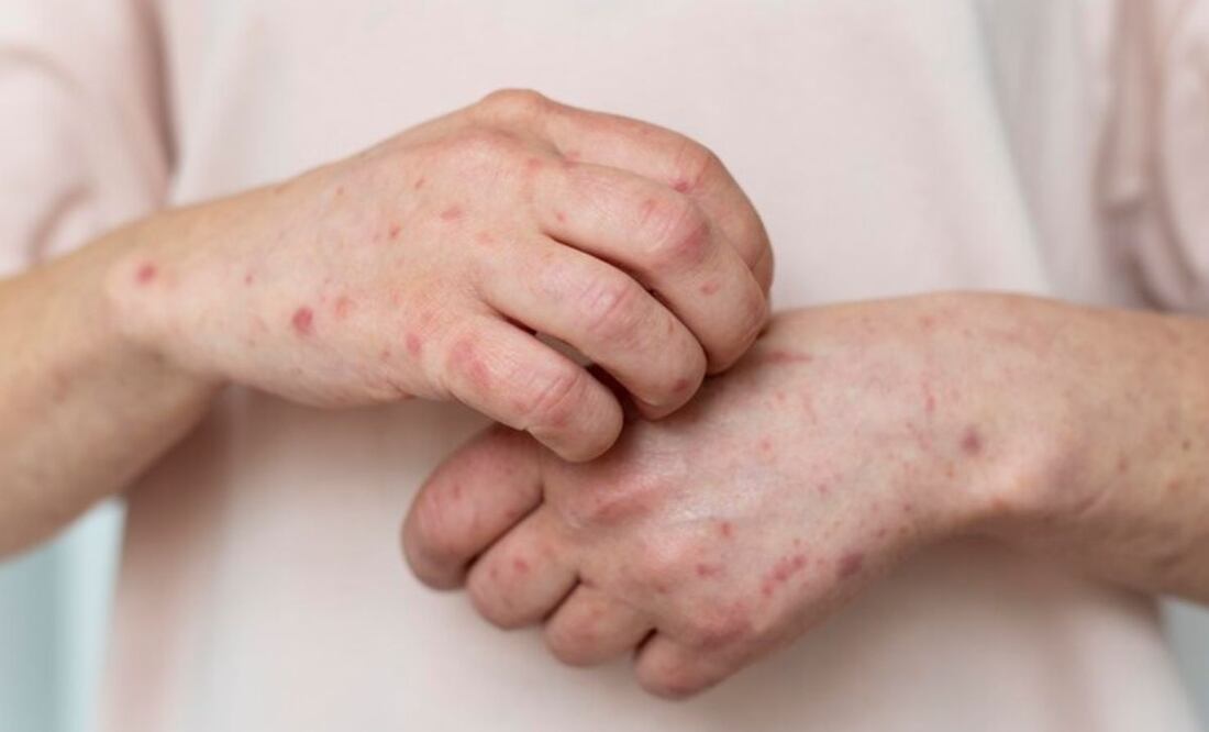 Los pacientes con urticaria crónica tardan más de 3 años en ser diagnosticados. Fuente: Freepik.