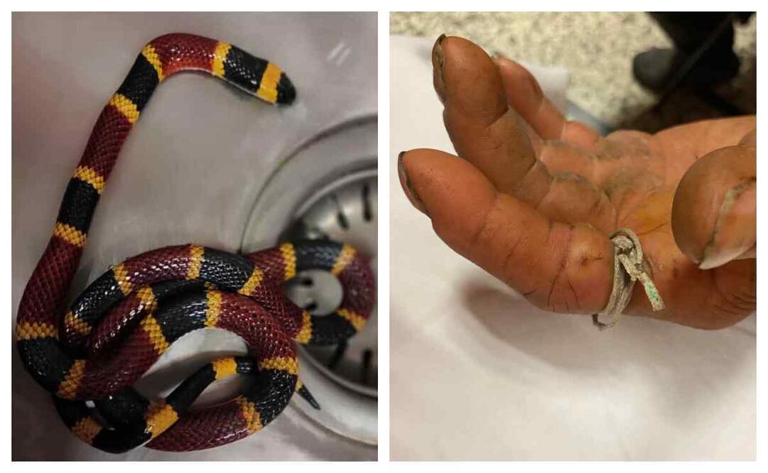 Atienden en el Hospital General de Pachuca a un hombre por picadura de víbora coralillo. Foto: Especial