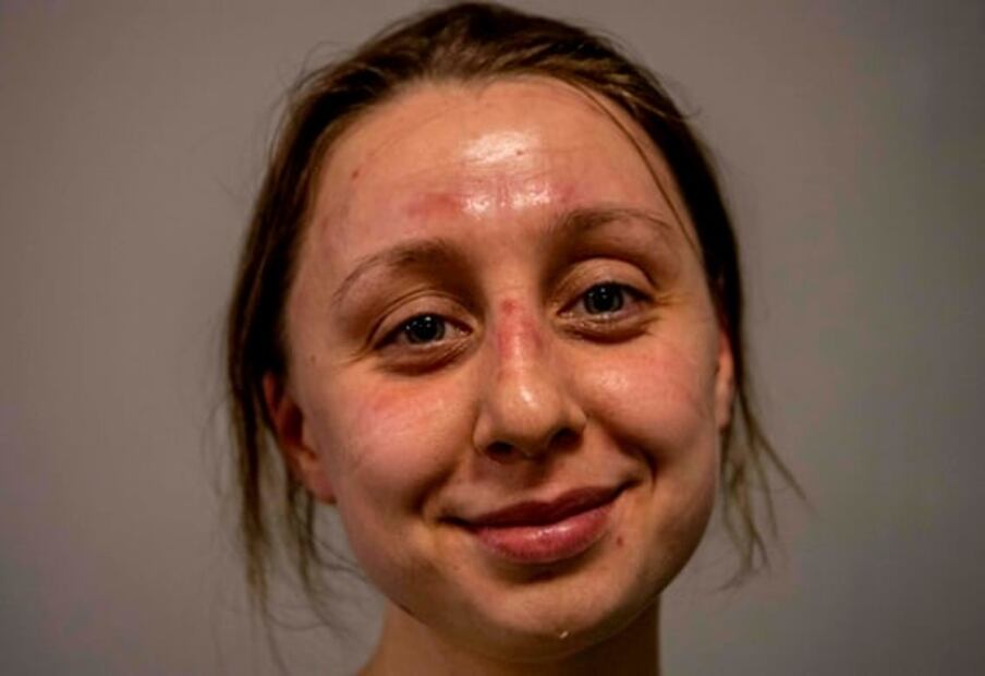 Así queda la cara al usar una mascarilla N95 13 horas seguidas