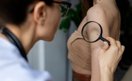 Descubre qué síntomas padecen las personas con queratosis seborreica