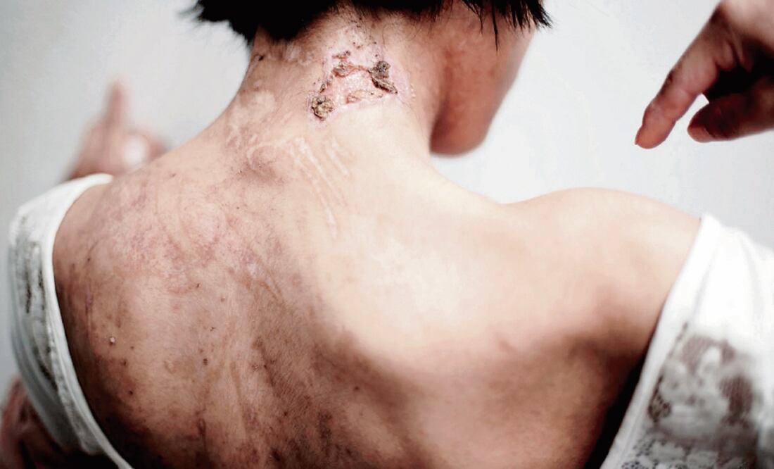 Maltrato. Leticia y su familia golpeaban a la joven hasta hacerla sangrar, luego le arrancaban las costras (ARCHIVO. EL UNIVERSAL)