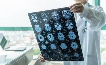 Alerta por epidemia de meningitis en Inglaterra; ¿Qué es y cómo afecta a la comunidad universitaria?