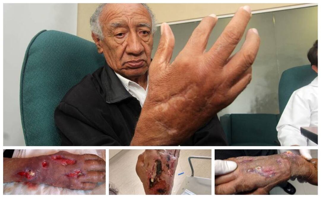 Pese a que Juan solicitó atención médica cuando su estado estaba avanzado, el equipo del Hospital General de Zona Número 20 La Margarita, del IMSS en Puebla, lograron remover el tejido muerto y mejorar su herida (OMAR CONTRERAS. EL UNIVERSAL)