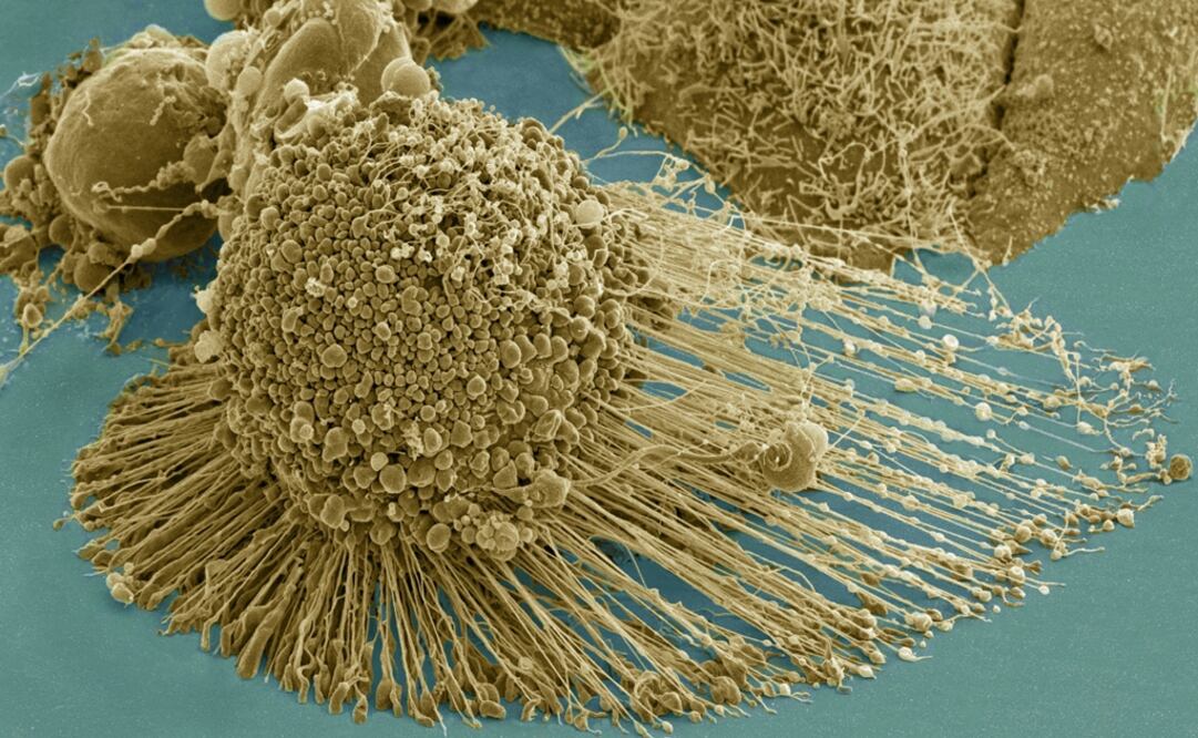 The MM mostly attacks the elderly. It starts in the bone marrow and it is one of the most common tumors to develop through the bloodstream after lymphoma - Photo: Tom Deerinck/AP