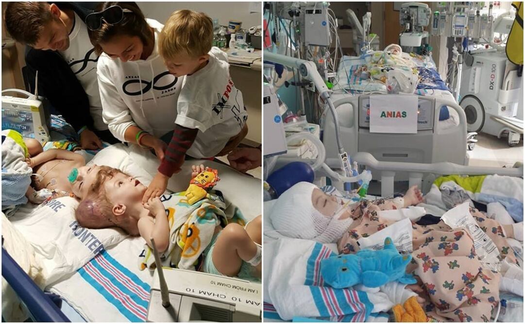 En redes sociales, Nicole McDonald publicó imágenes de Jadon y Anias, antes y después de la operación. /Tomadas de Facebook