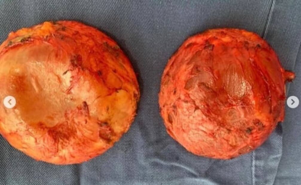 Conductora colombiana se quita implantes mamarios y llora al ver las fotos 