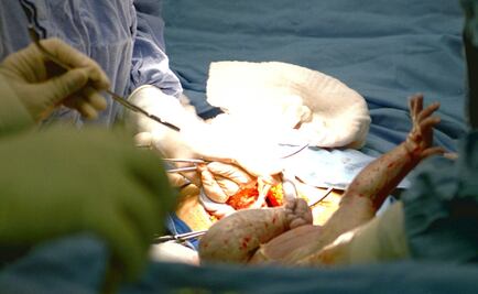 Los bebés nacidos por cesárea son más propensos a ser obesos