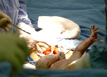 Los bebés nacidos por cesárea son más propensos a ser obesos