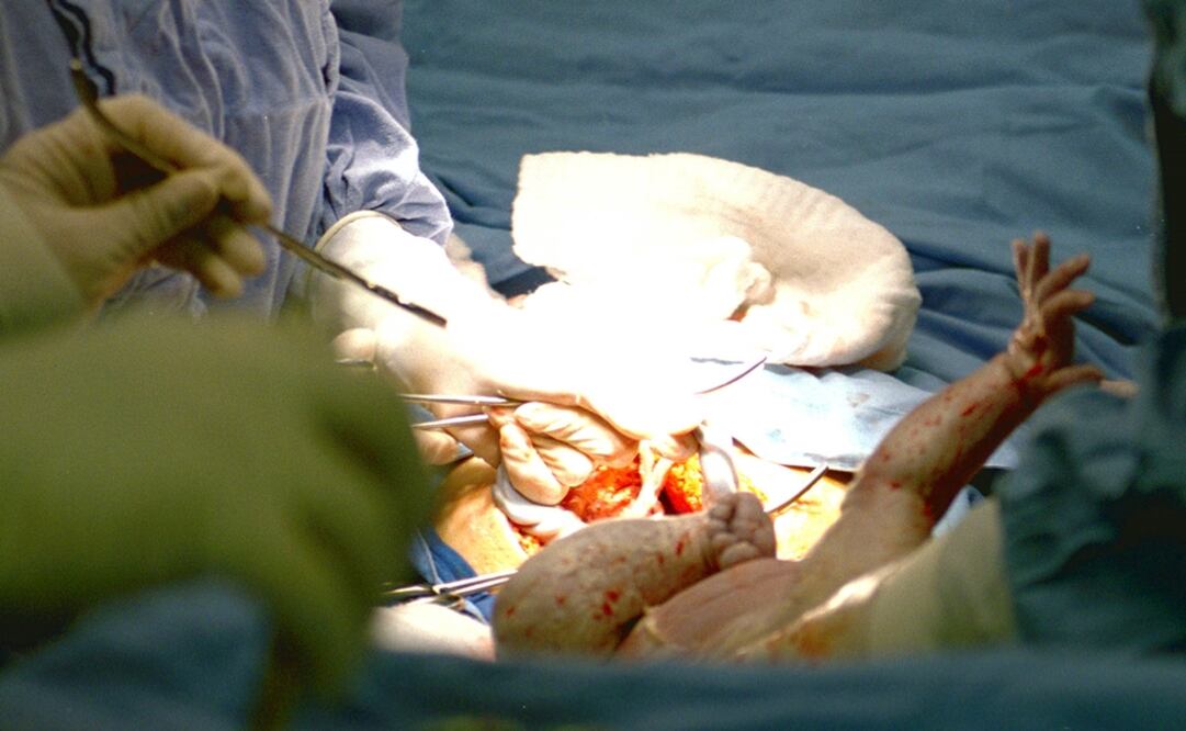 Los niños nacidos por cesárea eran 64% más propensos a ser obesos que los bebés nacidos por parto vaginal. (FOTO: Archivo/EL UNIVERSAL)