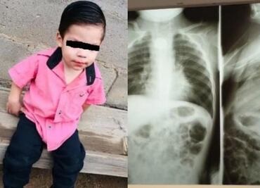 Bebé se traga pila y le quema el esófago; permanece grave en hospital de Sonora