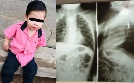 Bebé se traga pila y le quema el esófago; permanece grave en hospital de Sonora
