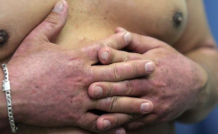 Lo que debes saber sobre la psoriasis