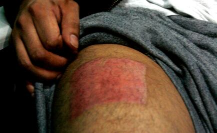 La UNAM crea un hidrogel sin fármacos para la cicatrización