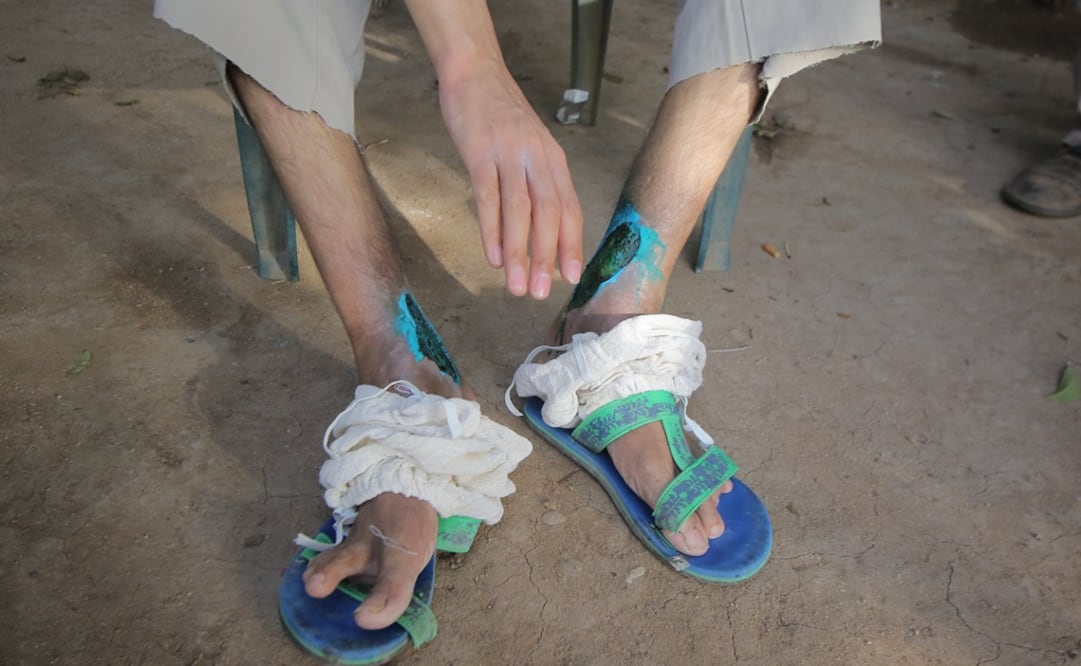 La situación económica de la familia de Jesús Francisco es crítica y las vendas para hacerle las curaciones son muy caras; una vecina le confeccionó unos protectores para que no se le contaminen las heridas, por las moscas.