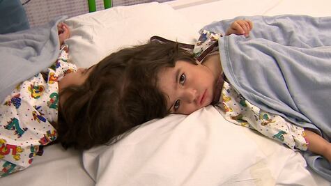 Así fue la cirugía con la que separaron las cabezas de unas siamesas