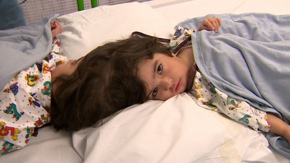 Las gemelas siamesas Safa y Marwa estaban unidas por la cabeza. Foto: BBC 