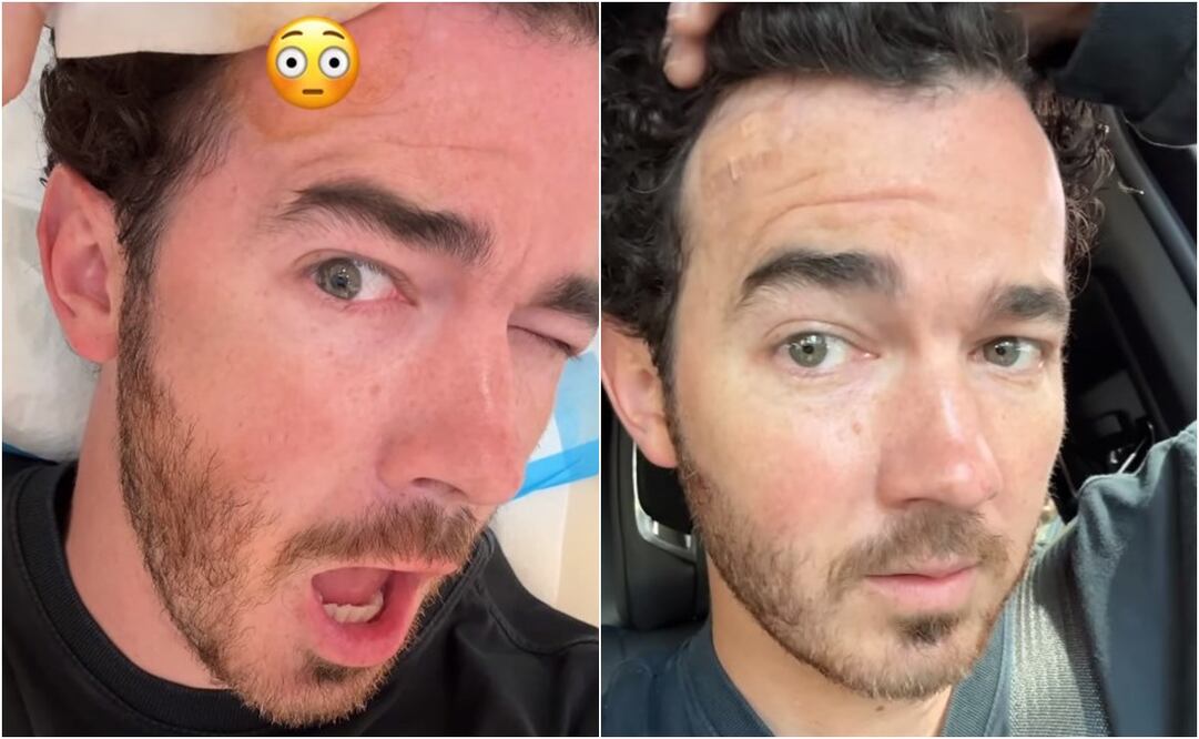 En el video, se puede ver a Kevin Jonas hablando y señalando un pequeño lunar sobre el que dice: "Ese es un pequeño cáncer de piel real que ha comenzado a crecer recientemente. Y ahora, tengo que someterme a una cirugía para extirparlo. Así que, aquí vamos".
