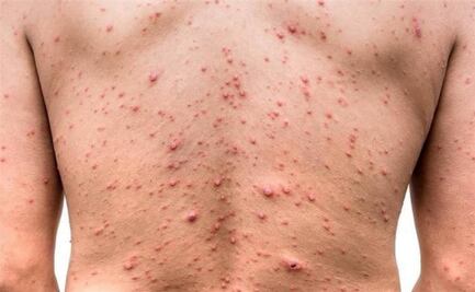 Sarampión, viruela, varicela y escarlatina: ¿cuáles son sus diferencias, síntomas y causas?; descúbrelo aquí