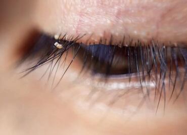 ¿Piojos en las pestañas? Sí, esto sucede y va en aumento