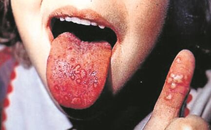 Aumentan contagios de virus Coxsackie