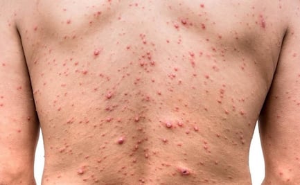 Suman 6 pacientes con viruela de mono en Morelos