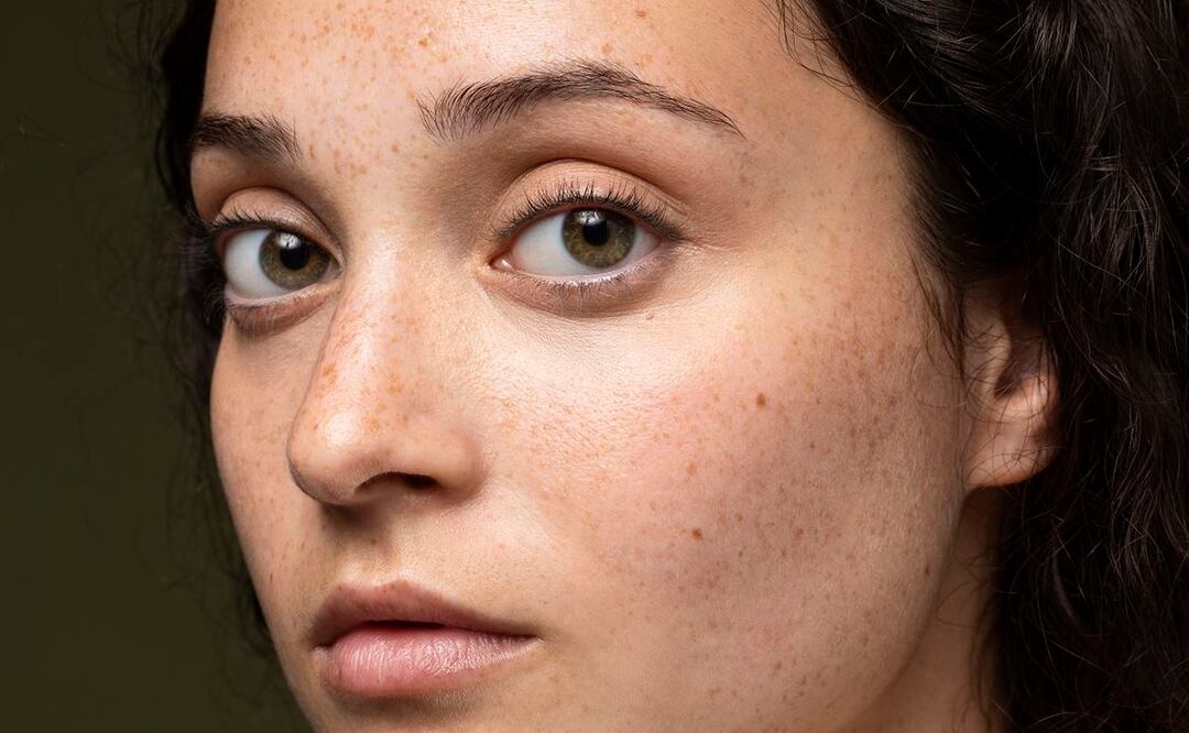 Las manchas causadas por la exposición prolongada al sol son comunes. Foto: Freepik