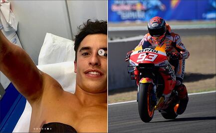 El piloto Marc Márquez presume las radiografías de su fractura