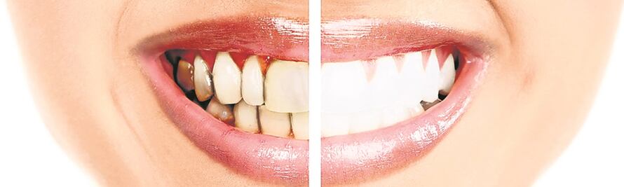 Enfermedad periodontal: el mal de los dientes flojos