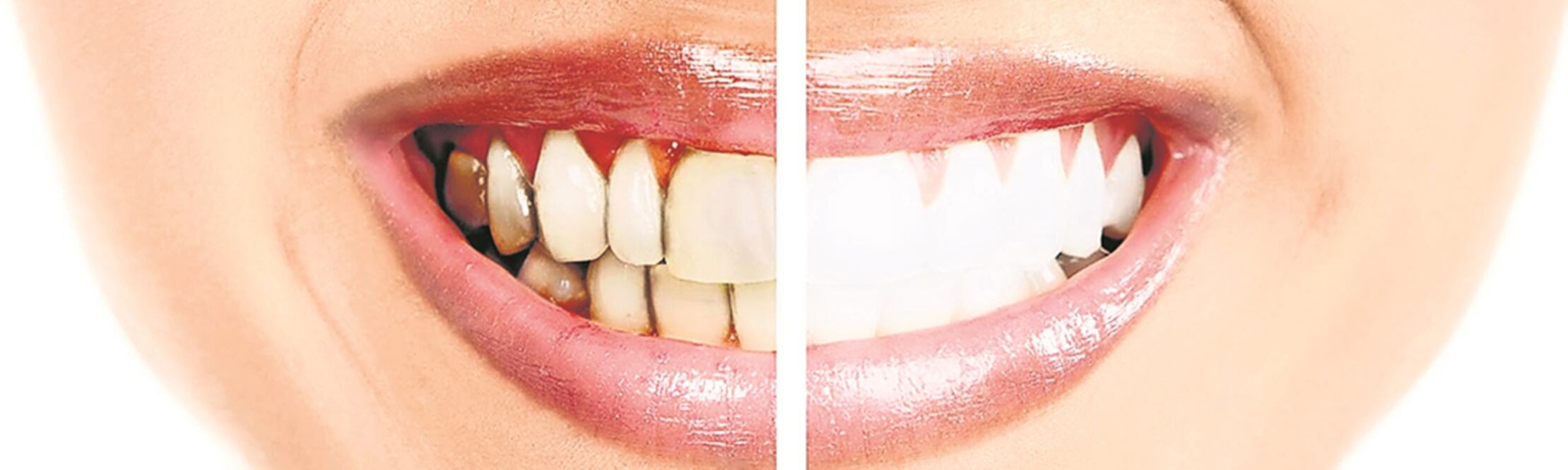 Al afectar el tejido periodontal o de soporte del diente, esta enfermedad ocasiona infecciones en la cavidad oral (ESPECIAL)