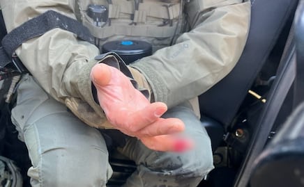 De una mordida, manifestante arranca dedo a agente en Minneapolis, acusan autoridades; Bondi informa que sujeto fue detenido