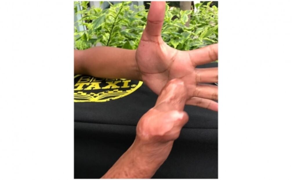 Juanito busca que con nueva cirugía le reconstruyan su mano 