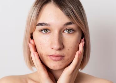 Estos son los alimentos que debes evitar para prevenir el acné hormonal