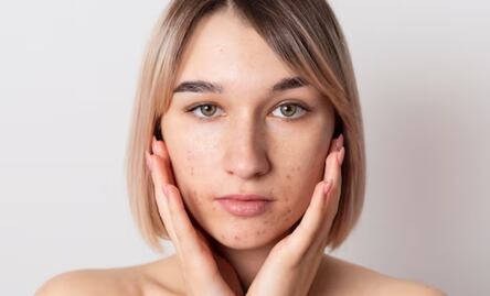 Estos son los alimentos que debes evitar para prevenir el acné hormonal