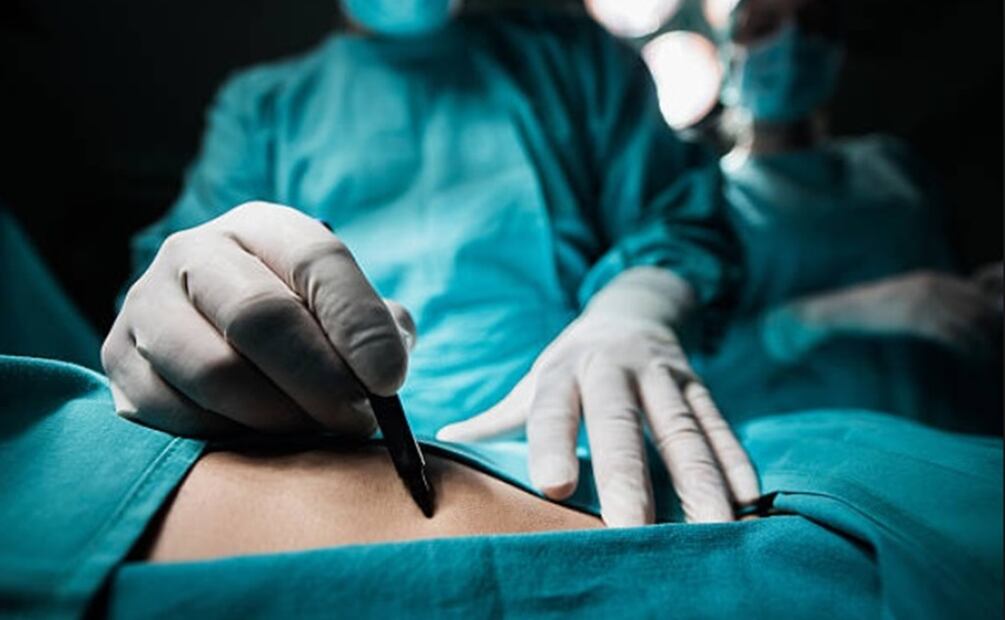 La operación se realizó en varias fases: en primer lugar, el equipo de cirugía oncológica extirpó el riñón derecho, que debido al tumor, tenía un tamaño 10 veces mayor de lo normal, y luego los cardiólogos detuvieron temporalmente el corazón de la niña con circulación extracorpórea para retirar la parte del tumor que había invadido la aurícula derecha. Foto: Archivo EL UNIVERSAL