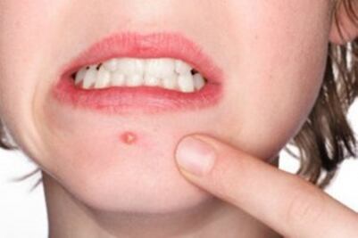 Acné afecta a 9.4% de la población a nivel mundial