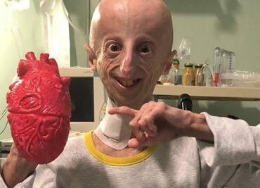 Fallece Sammy Basso, científico italiano con progeria que investigaba sobre su enfermedad