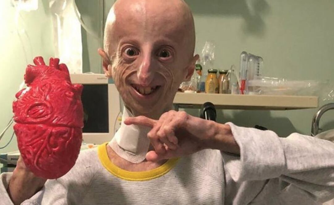 Sammy Basso es uno de los 119 pacientes en todo el mundo con el Síndrome de Progeria Hutchinson-Gilford. Foto: Facebook / Sammy Basso