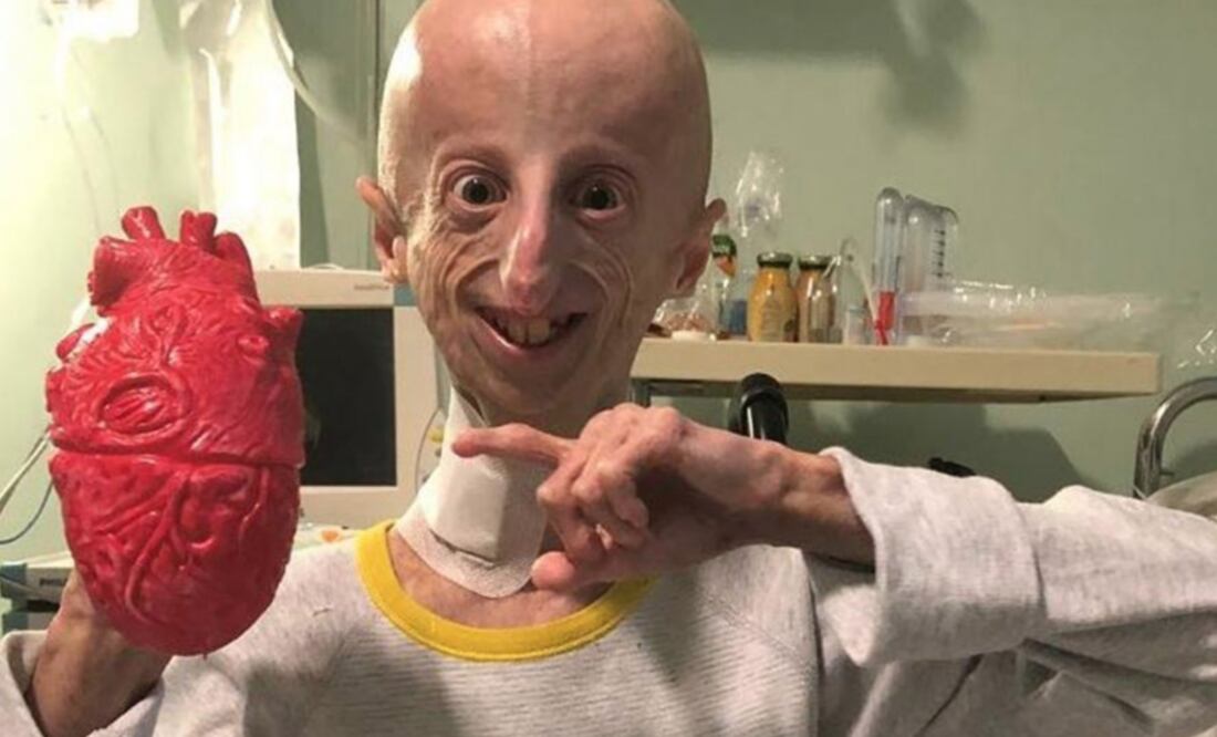 Sammy Basso es uno de los 119 pacientes en todo el mundo con el Síndrome de Progeria Hutchinson-Gilford. Foto: Facebook / Sammy Basso