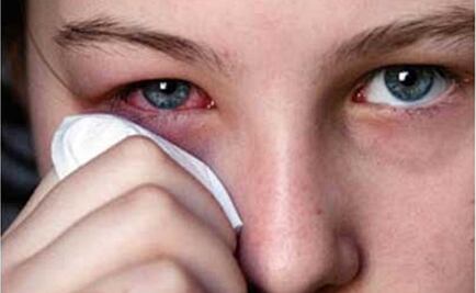 Reportan brote de conjuntivitis en Yucatán 