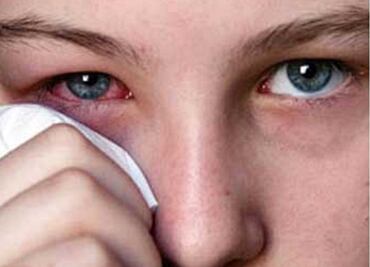 Reportan brote de conjuntivitis en Yucatán