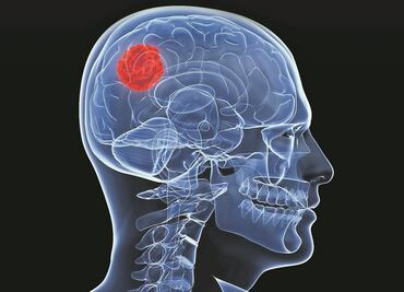 Fármaco disminuye crecimiento de tumores cerebrales